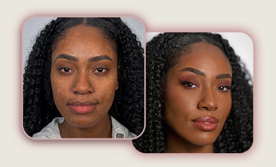 Antes e depois: pele negra com manchas