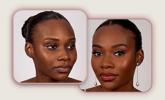 Antes e depois: pele negra com hiperpigmentação