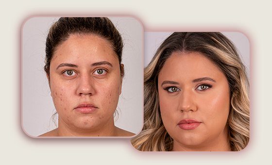 Antes e depois de noiva com cicatriz e acne