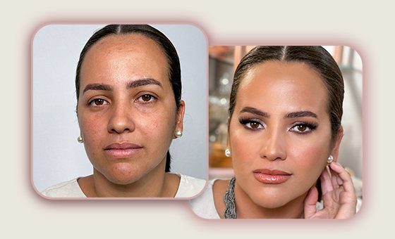 Antes e depois: pele com melasma