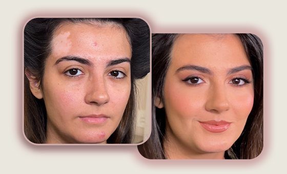 Antes e depois: técnica de vitiligo